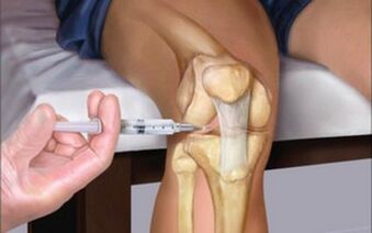 intra-articular injection for osteoarthritis