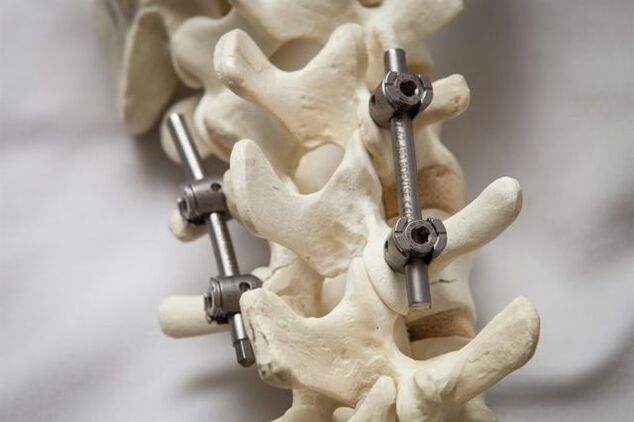 fixation of cervical spine osteochondrosis