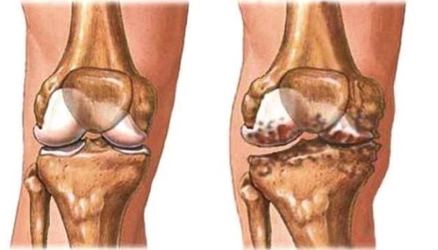 healthy knees and knee arthrosis