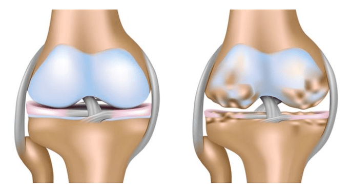 damage to the knee joint with healthy cartilage and arthrosis