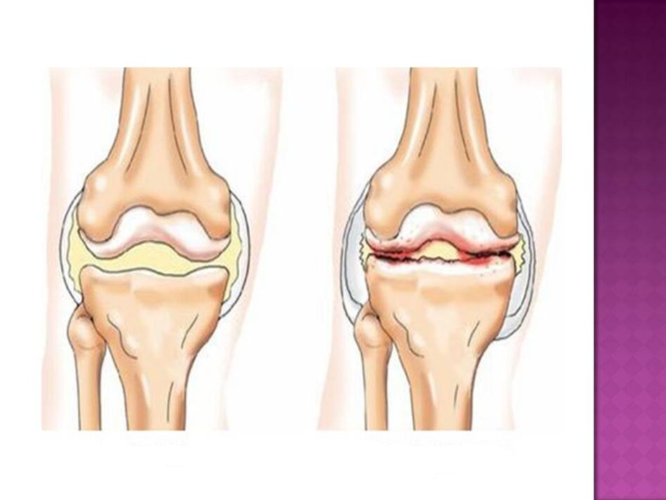A joint is normal (left) and affected by osteoarthritis (right)