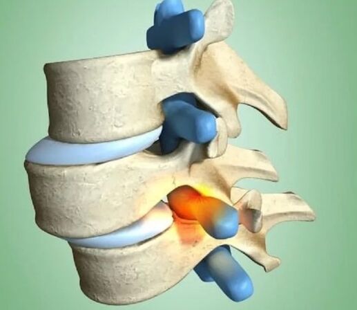 Unstable position of vertebrae