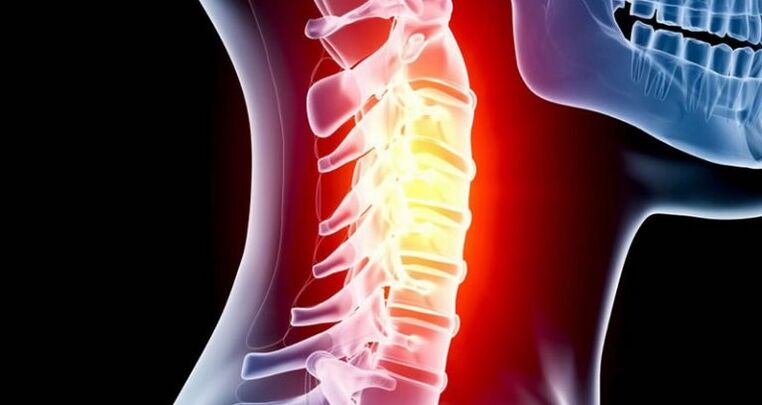 The inflammation of the cervical region