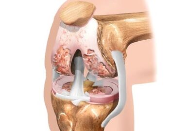 Damage to knee joint artrosis