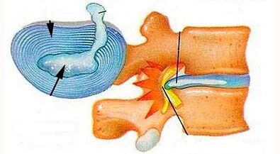 Features of the development of cervical osteocondrosis
