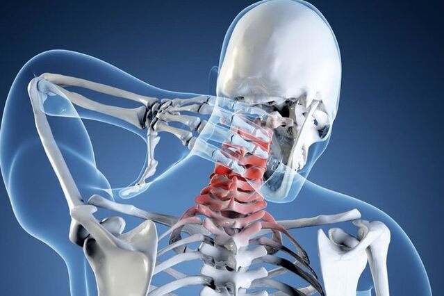 osteochondrosis of the cervical spine